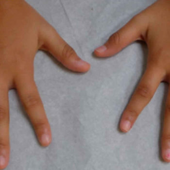 juvenile idiopathic arthritis