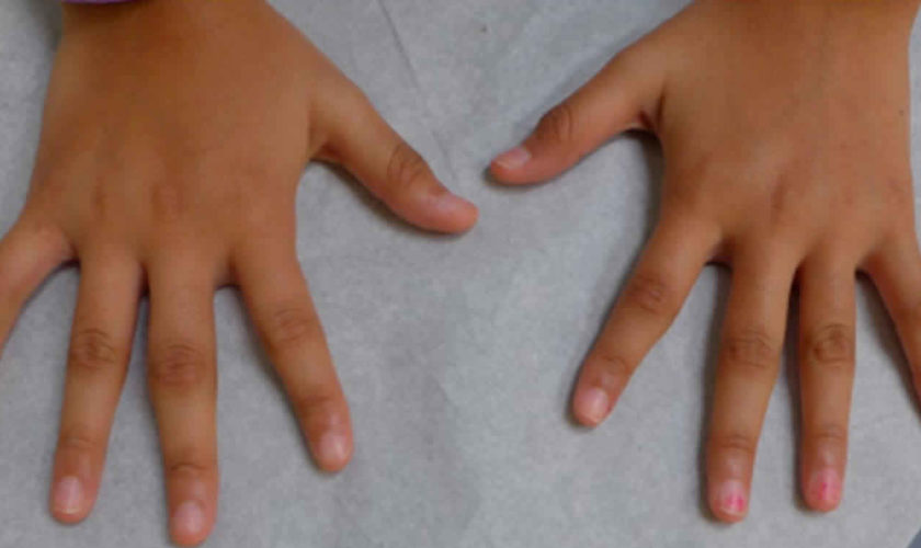 juvenile idiopathic arthritis