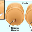 meatal-stenosis