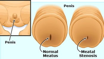 meatal-stenosis