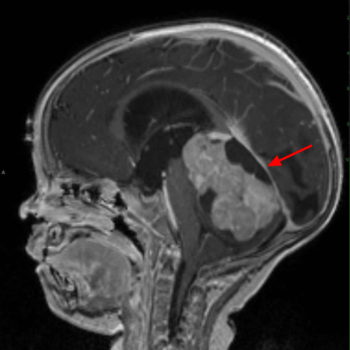 medulloblastoma