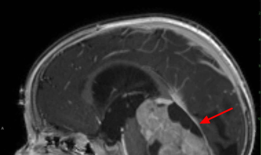 medulloblastoma