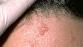 molluscum-contagiosum