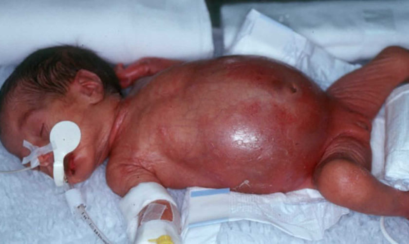 necrotizing enterocolitis
