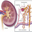 nephrotic syndrome