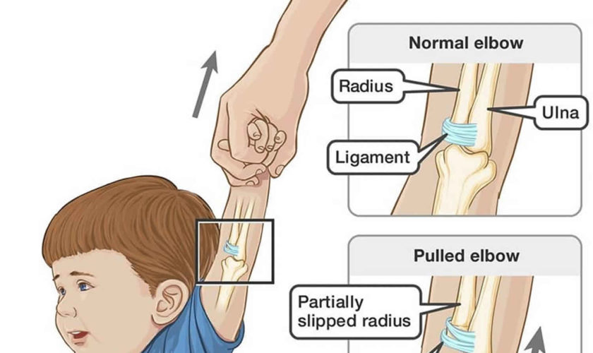 nursemaid’s elbow