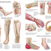 osteomyelitis