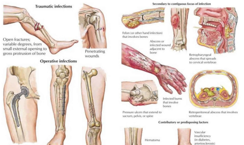 osteomyelitis