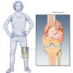 osteosarcoma