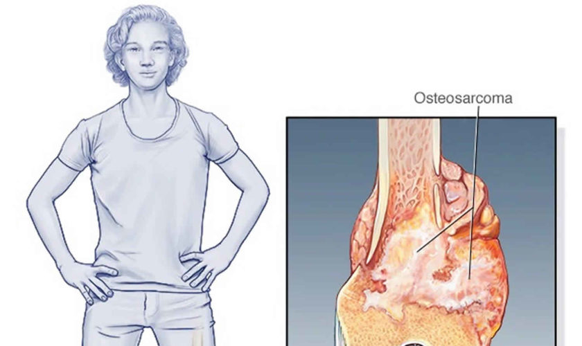 osteosarcoma