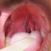 peritonsillar abscess