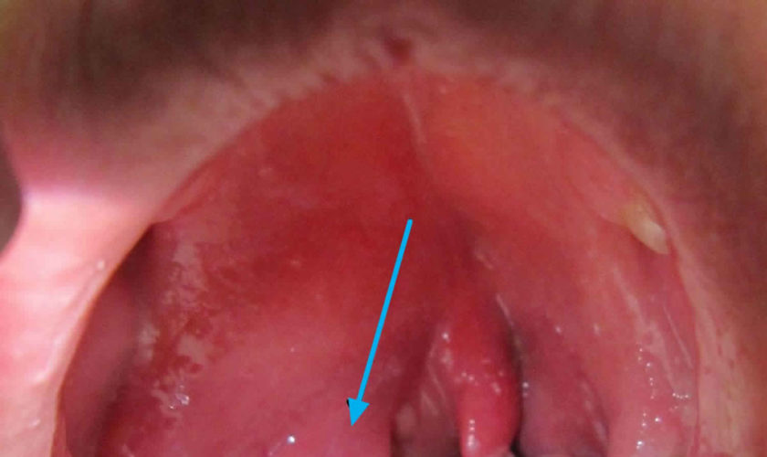 peritonsillar abscess