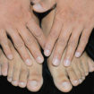 polydactyly