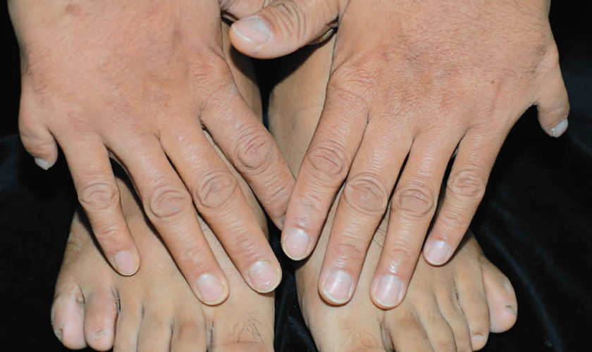 polydactyly
