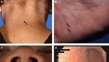 pten hamartoma tumor syndrome