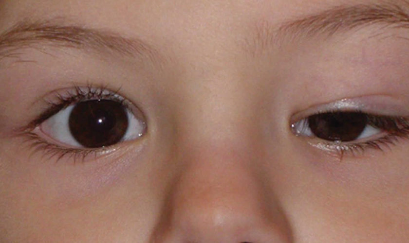 ptosis