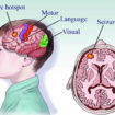 refractory epilepsy