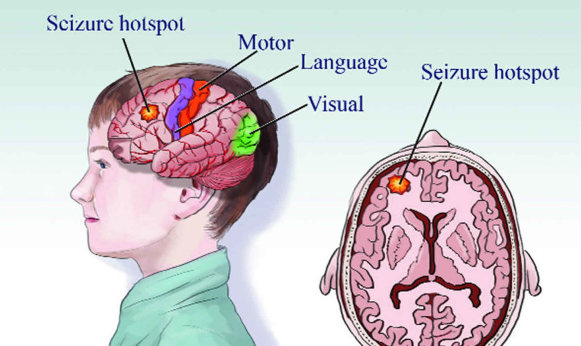 refractory epilepsy