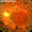 retinitis pigmentosa