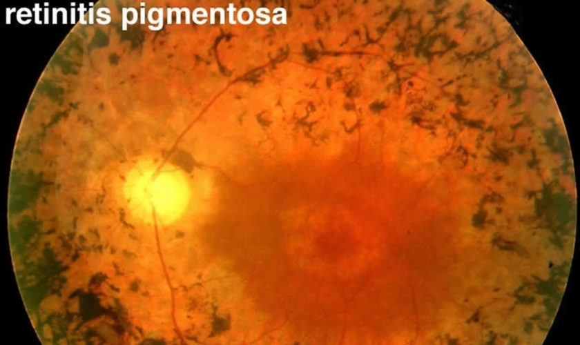 retinitis pigmentosa