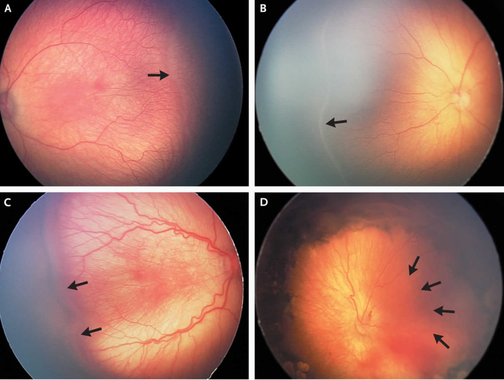 Retinopathy Of Prematurity Causes Diagnosis Screening Treatment And Prognosis