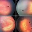 retinopathy of prematurity