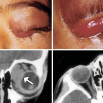 rhabdomyosarcoma