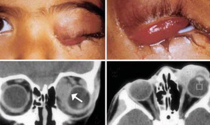 rhabdomyosarcoma
