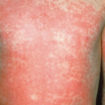 Scarlet fever rash