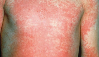 Scarlet fever rash