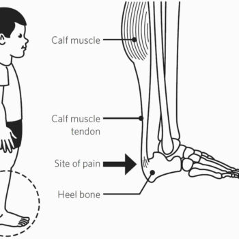 sever’s disease