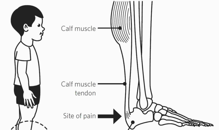 sever’s disease