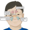 sinus infection in kids