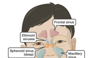 sinus infection in kids