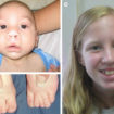 smith-lemli-opitz-syndrome
