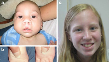 smith-lemli-opitz-syndrome