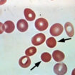 spherocytosis