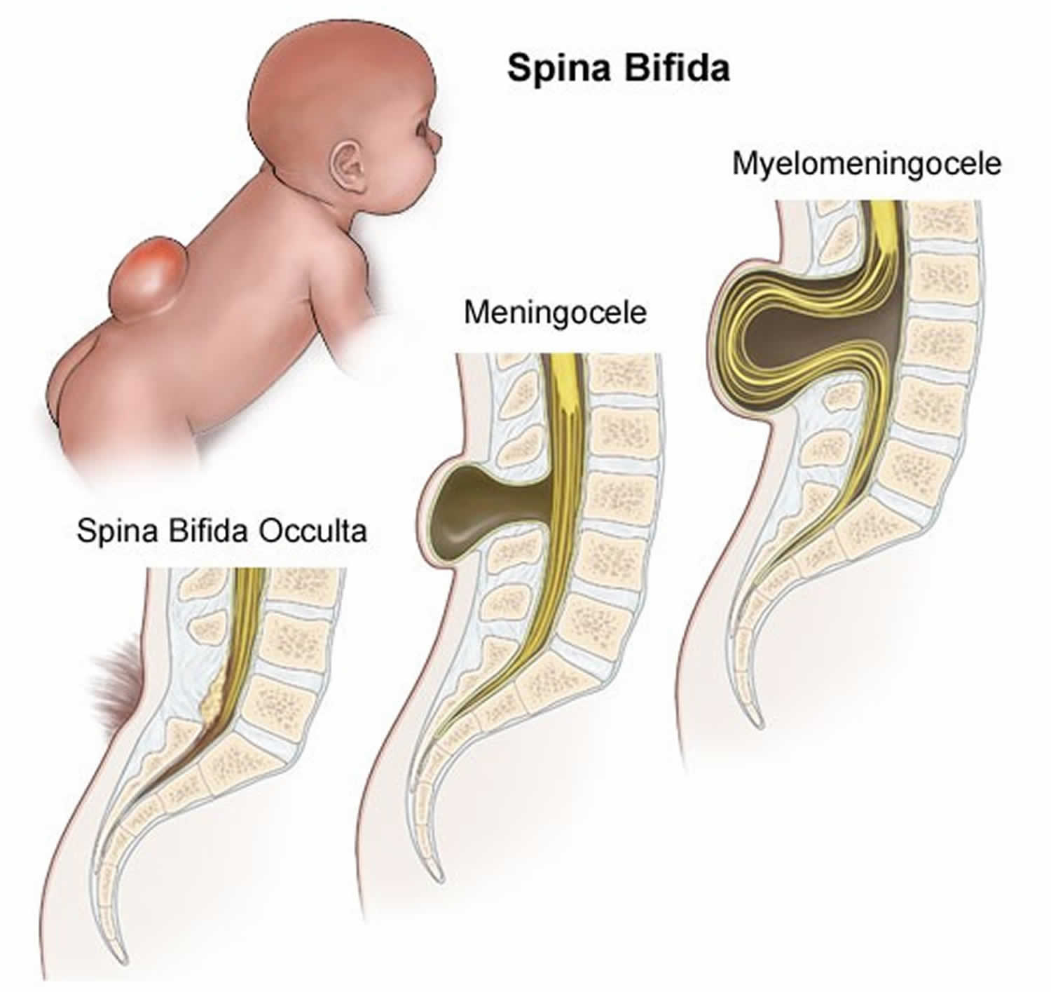 Спина бифида фонд. Spina Bifida (расщепление позвоночника). Менингоцеле пояснично-крестцового. Дефект нервной трубки спина бифида.