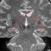 temporal lobe epilepsy