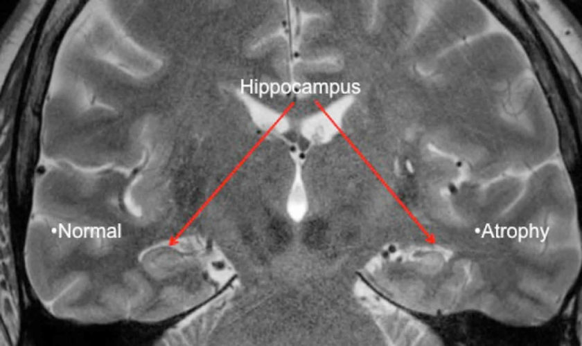 temporal lobe epilepsy