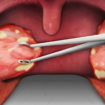 tonsillectomy