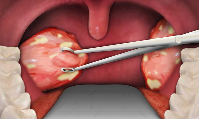 tonsillectomy