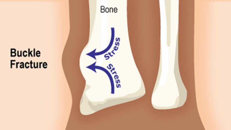 Buckle fracture causes, symptoms, diagnosis & treatment