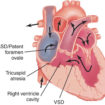 tricuspid atresia