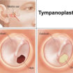 tympanoplasty