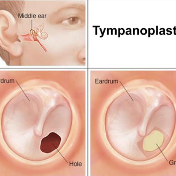 tympanoplasty