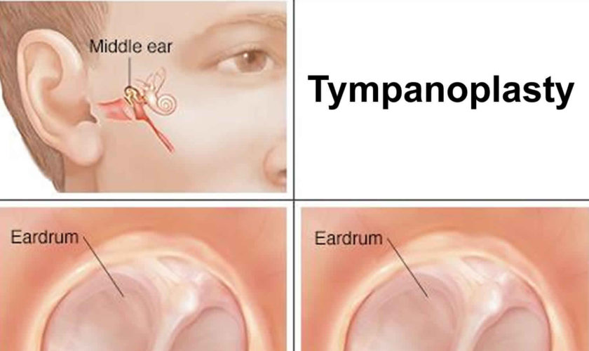 tympanoplasty