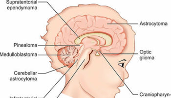 Brain tumor in children