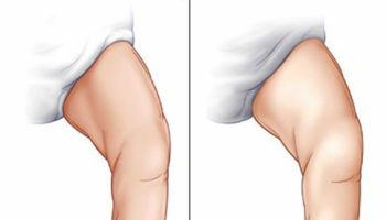 Calcaneovalgus foot