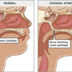 Choanal-atresia